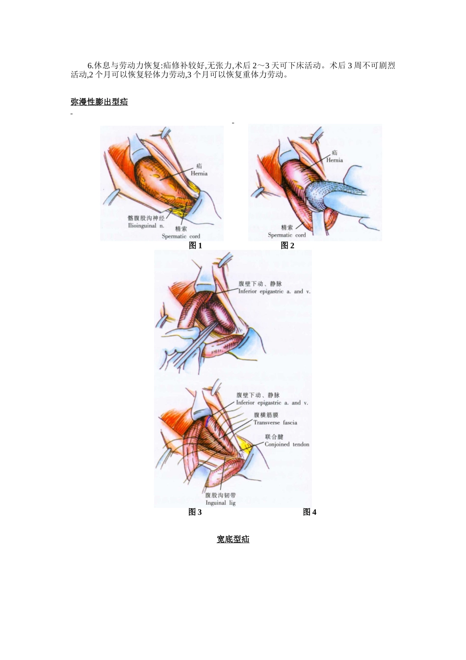 腹股沟直疝修补术_第2页