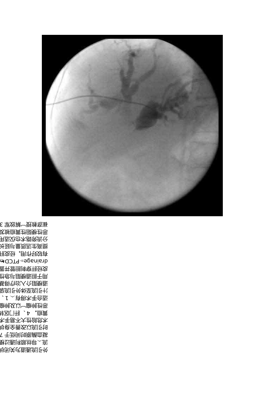 经皮穿刺肝胆管引流术_第2页