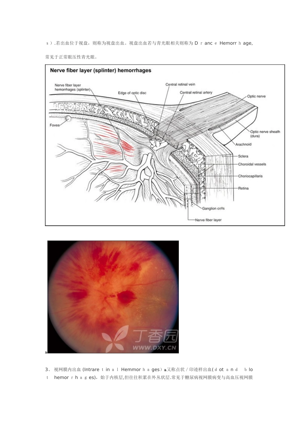 视网膜各层出血解析_第2页