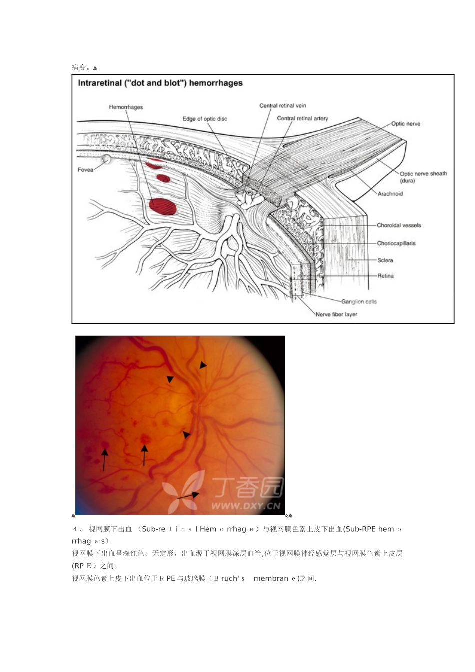 视网膜各层出血解析_第3页