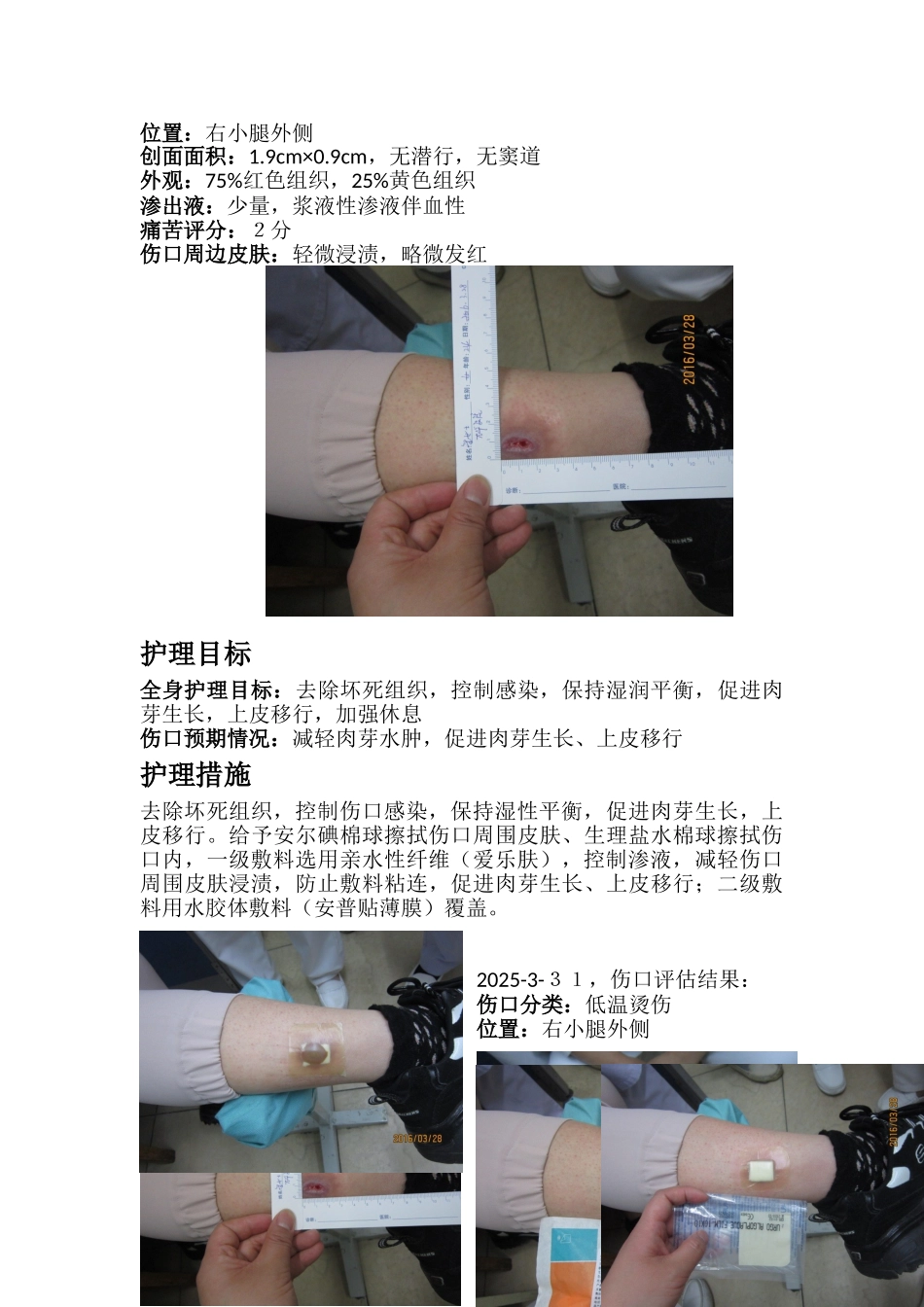 低温烫伤后伤口护理_第2页