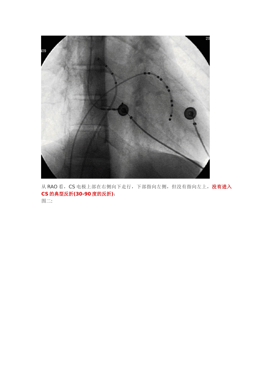 冠状窦电极的放置_第2页