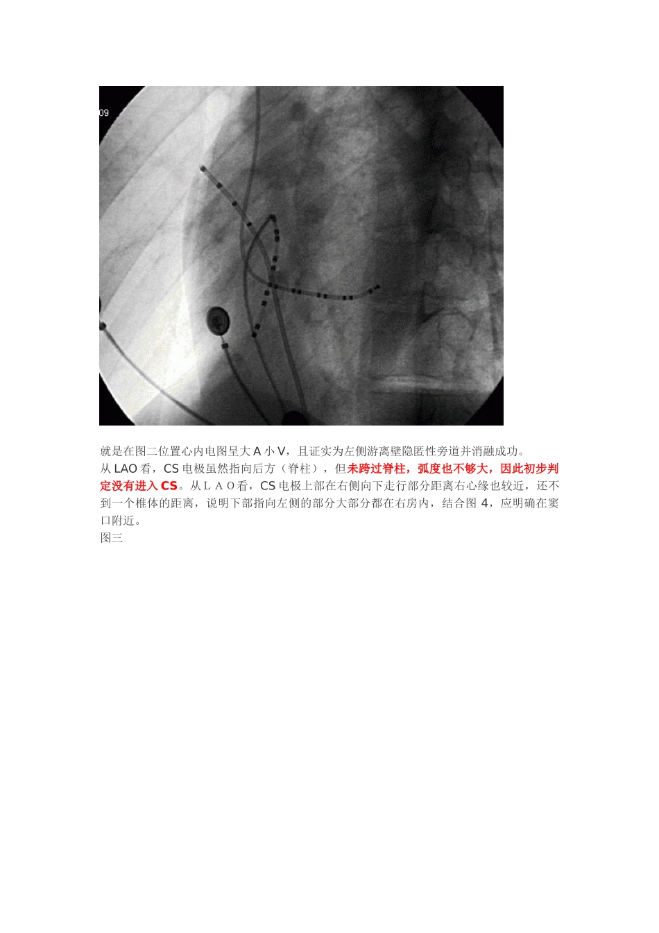 冠状窦电极的放置_第3页