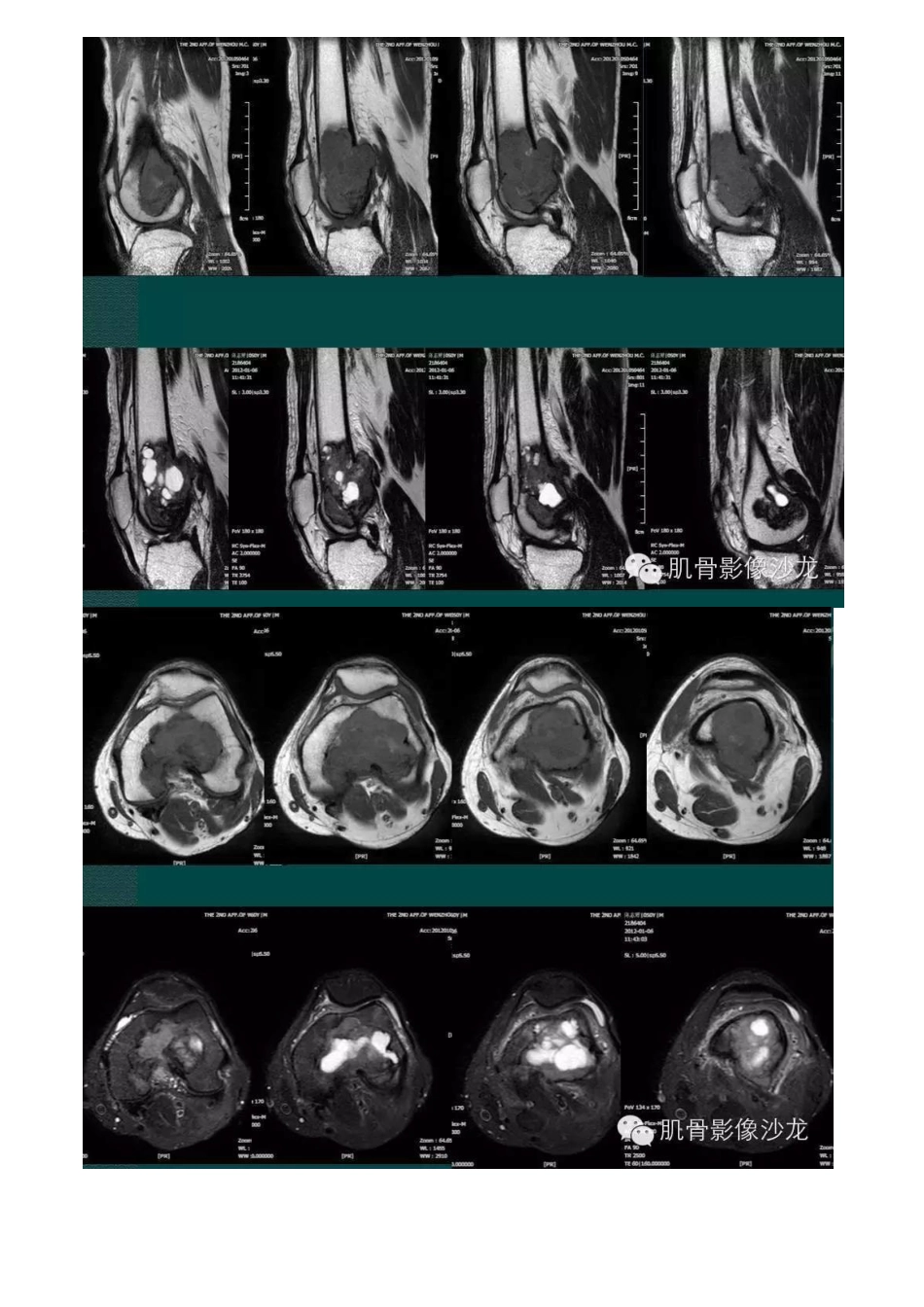 医学影像：良性纤维组织细胞瘤_第2页