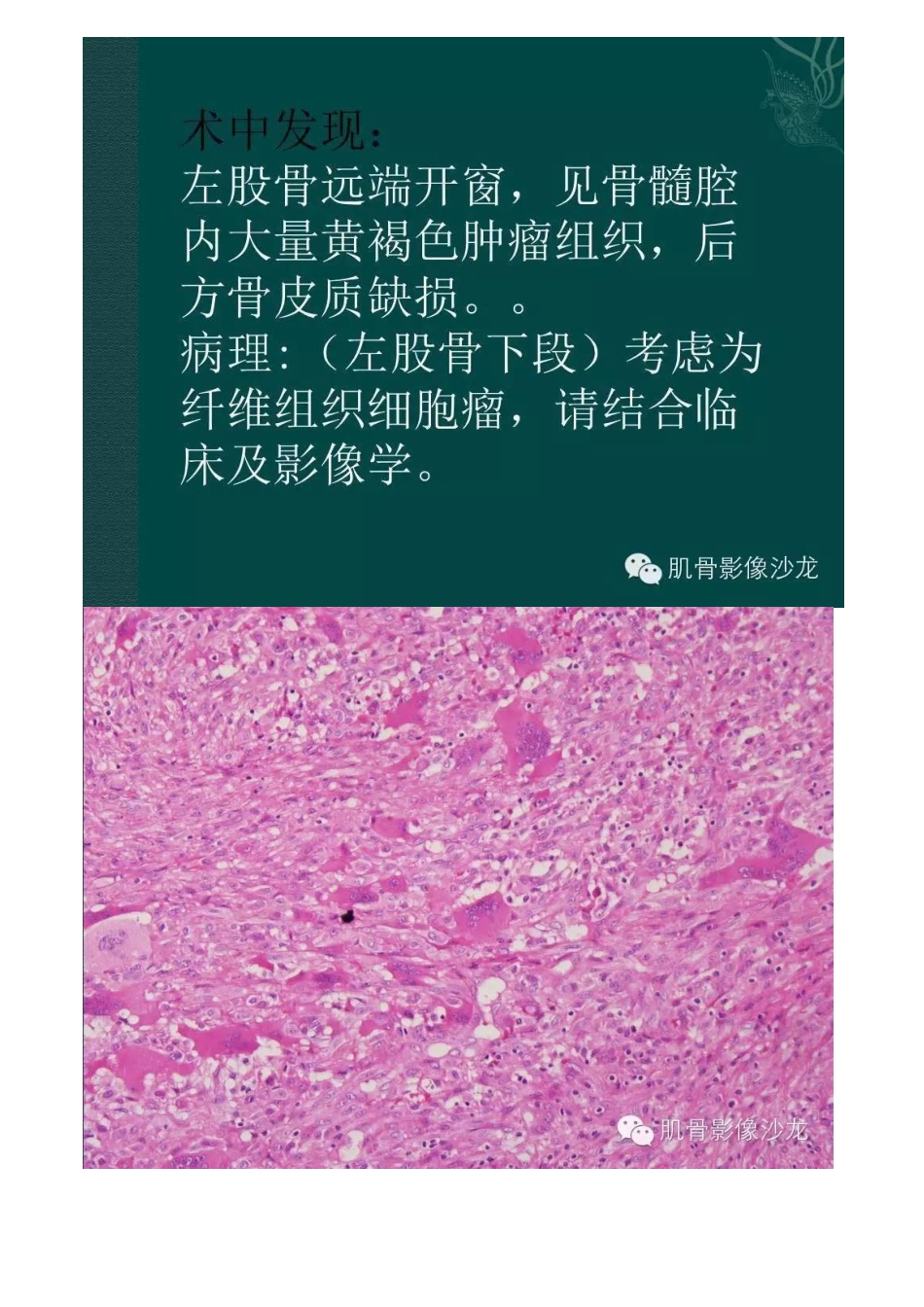 医学影像：良性纤维组织细胞瘤_第3页