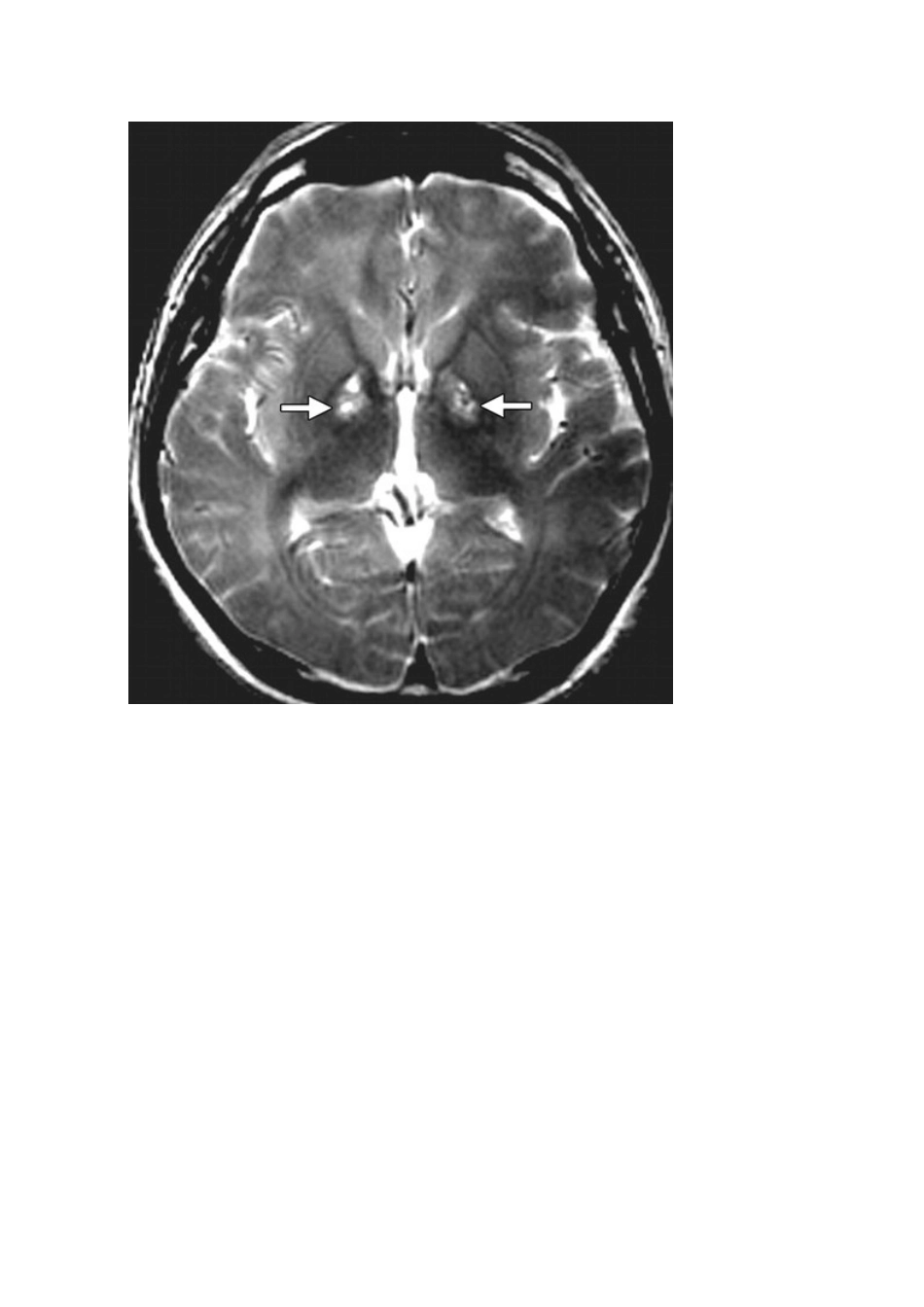 基底节区域异常的疾病逐一鉴别_第2页