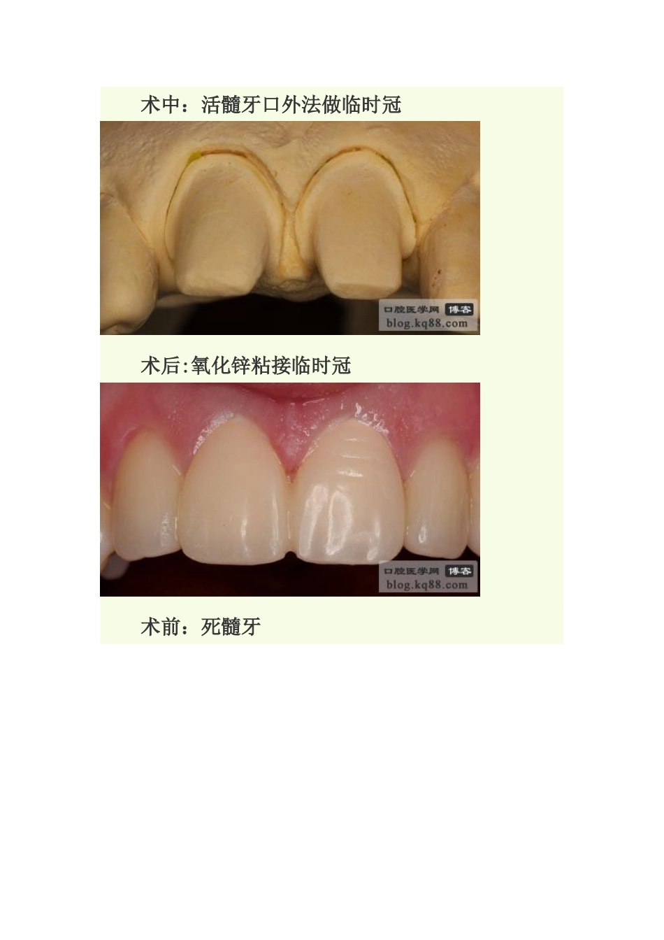 临时冠的制作方法与临床应用_第2页