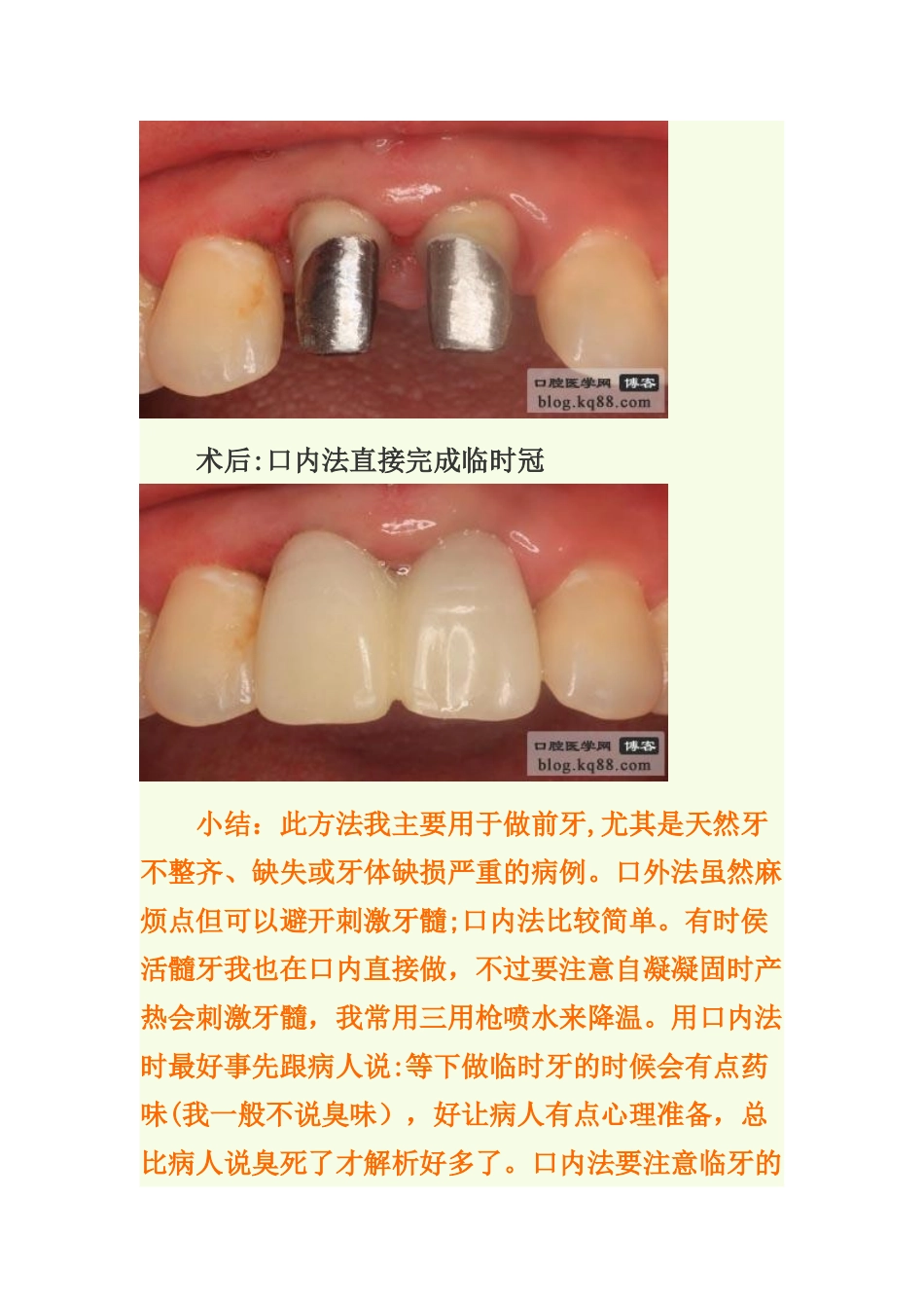 临时冠的制作方法与临床应用_第3页