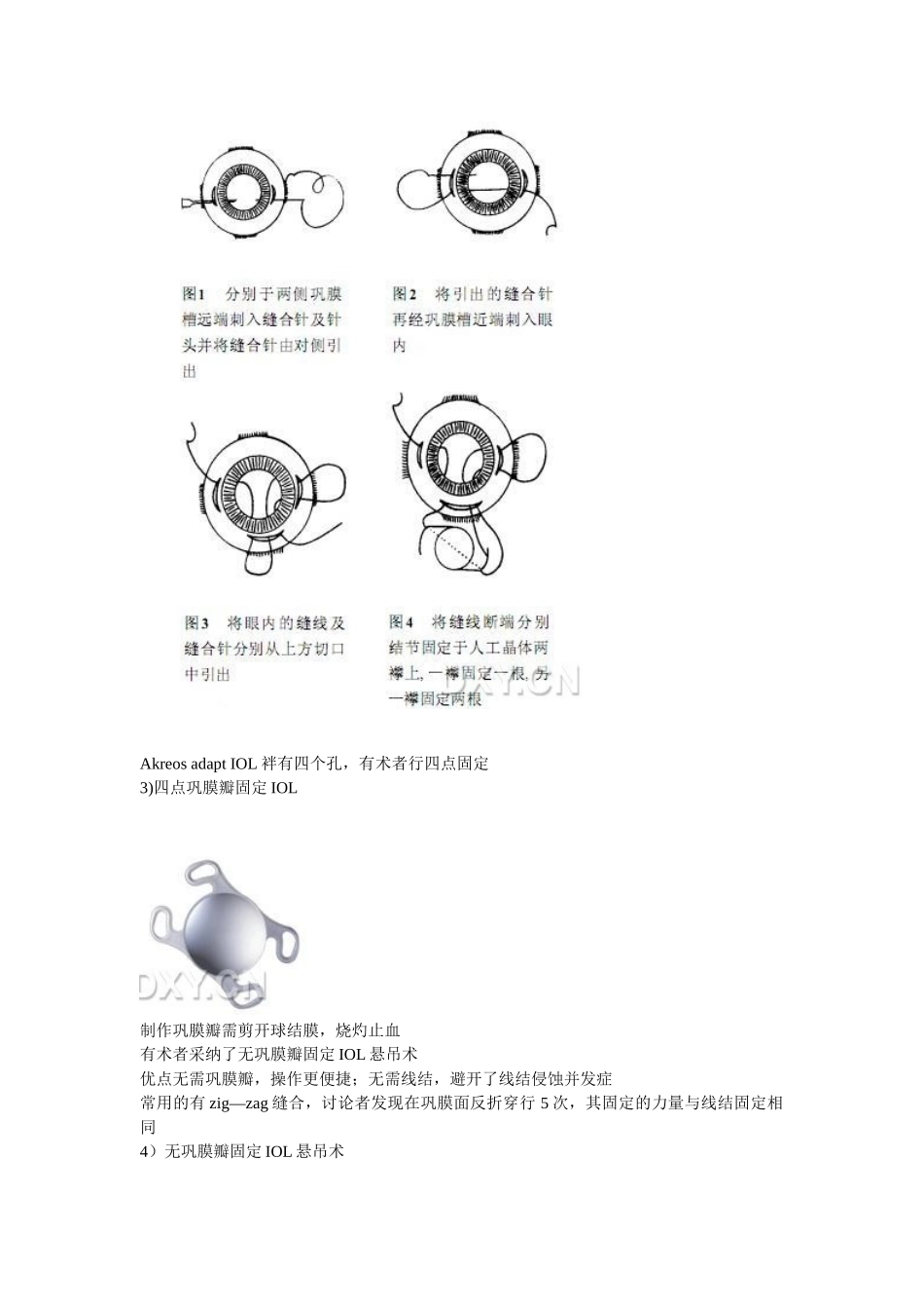 人工晶状体悬吊固定术_第2页
