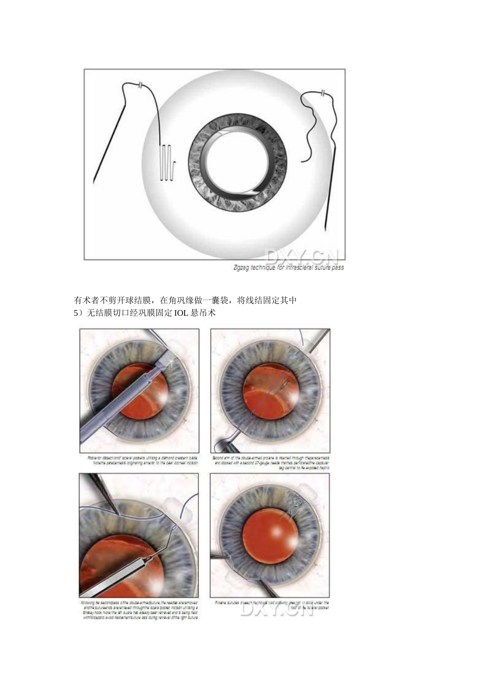 人工晶状体悬吊固定术_第3页