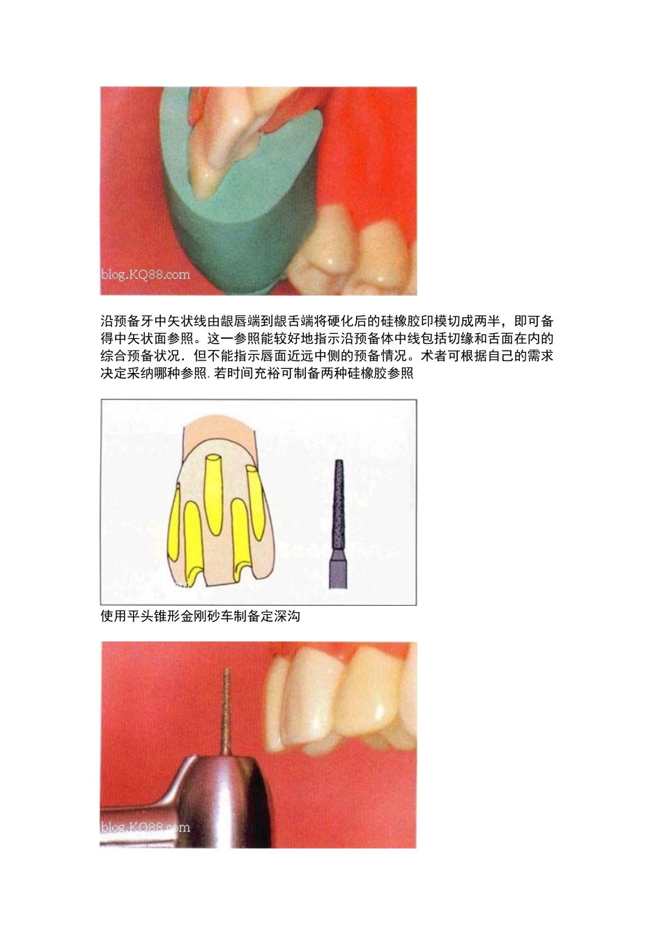 全瓷牙备牙方法图例_第3页