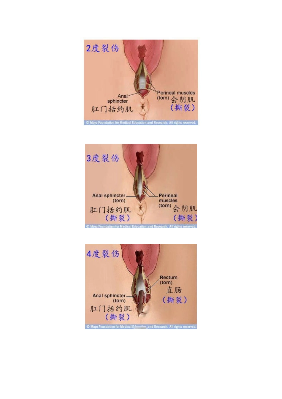 分娩时-会阴撕裂伤分级示意图_第2页