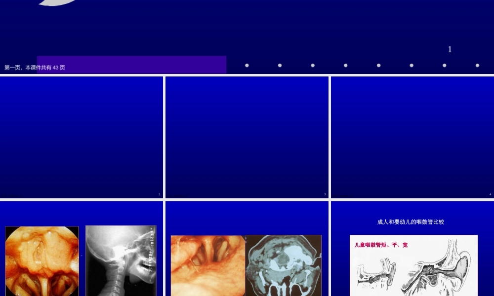 分泌性中耳炎PPT课件课件精选课件