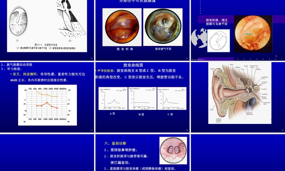 分泌性中耳炎PPT课件课件精选课件
